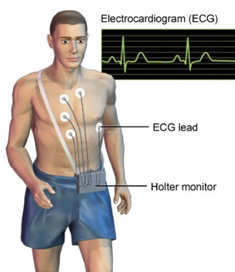 ecg holter καλώδιο